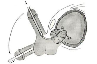 Schemat endoskopowej operacji powiększenia penisa