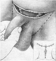 Chirurgiczne wydłużenie penisa poprzez wyciągnięcie jego ukrytej części